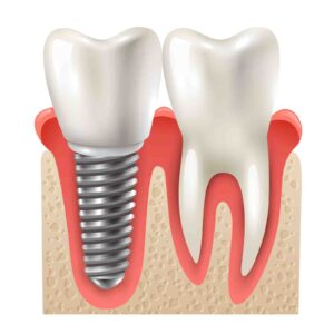 Dental Implants Cincinnati Ohio