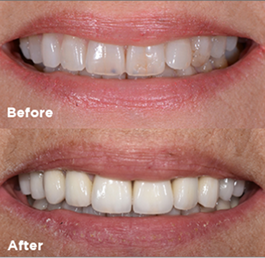 Before and after smile makeover