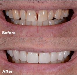 Before and after smile makeover
