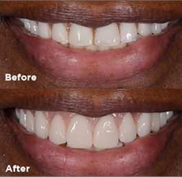 Before and after smile makeover