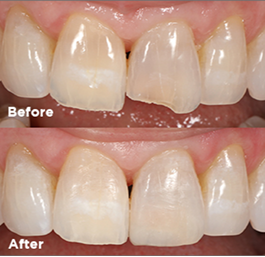 Before and after smile makeover