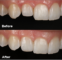 Before and after smile makeover