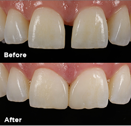 Before and after smile makeover