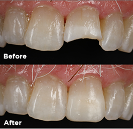 Before and after smile makeover