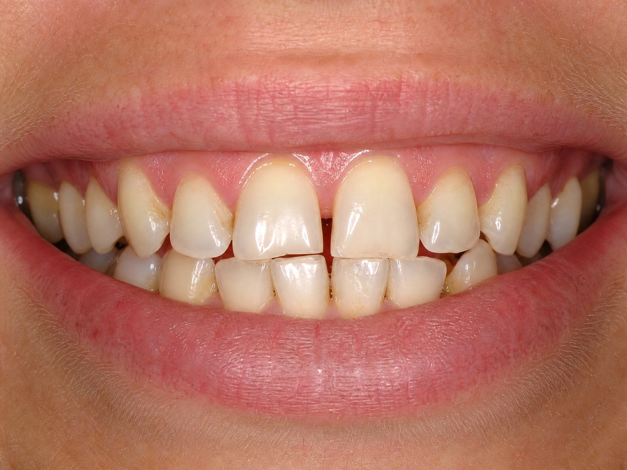 Patient smile before cosmetic dentistry