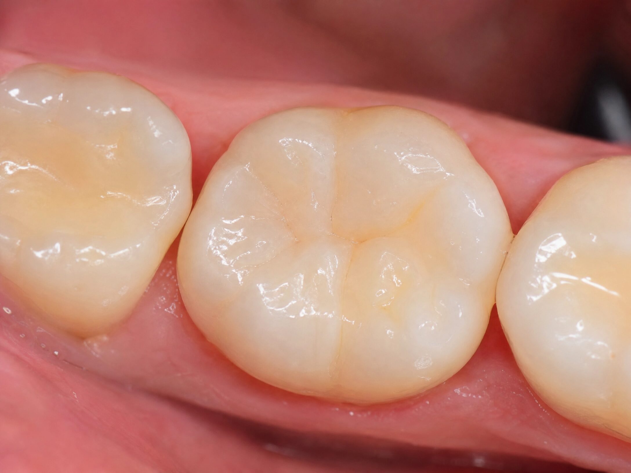 Close-up of a perfectly matched tooth-colored composite filling